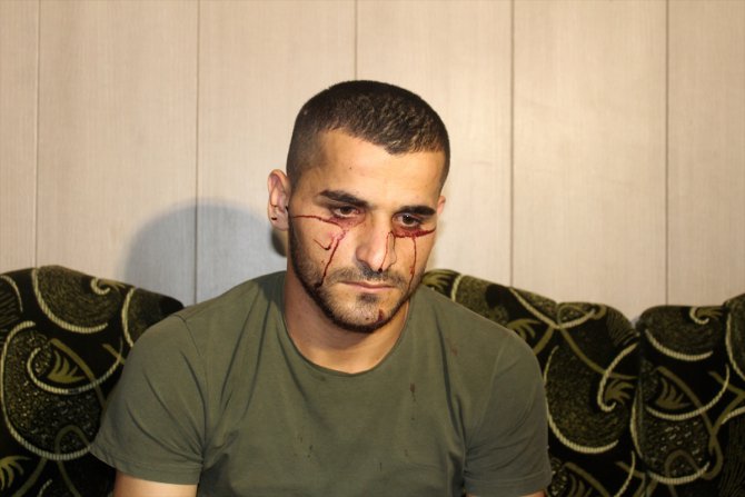 "Kan ağlayan" Iraklı genç hastalığına çare arıyor