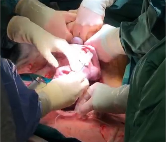 Anne karnındaki 32 haftalık bebek sezaryen doğum sırasında ameliyat edildi