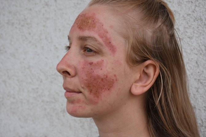 Güzellik merkezinde bakım yaptırdıktan sonra yüzünde yanıklar oluşan kişi polise başvurdu