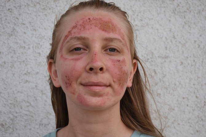 Güzellik merkezinde bakım yaptırdıktan sonra yüzünde yanıklar oluşan kişi polise başvurdu