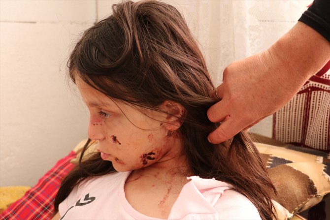 Samsun'da pitbull saldırısına uğrayan çocuk yaralandı